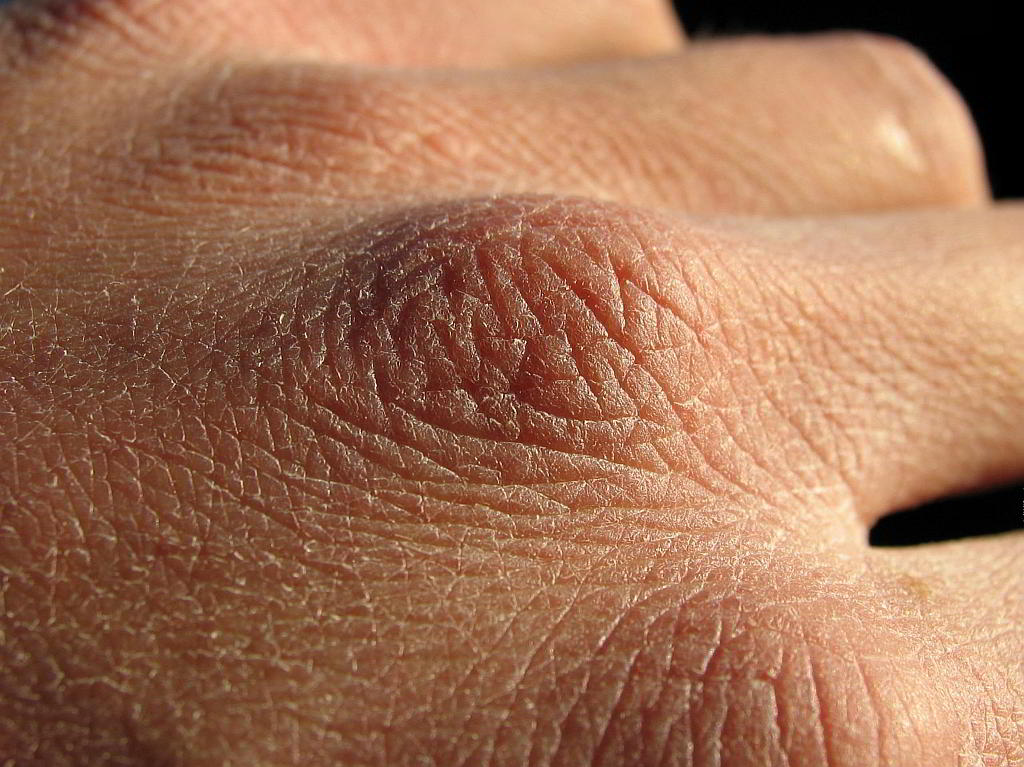 Bild Trockene Haut an Handknöcheln - EYVA Blog
