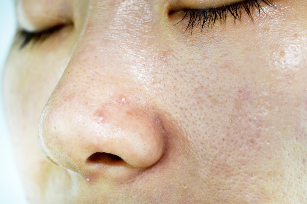 Fettige Haut glänzt und ist gekennzeichnet von großen Poren und Unreinheiten. © shutterstock.com